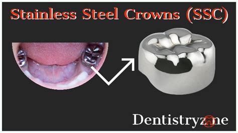prefabricated stainless steel crown permanent